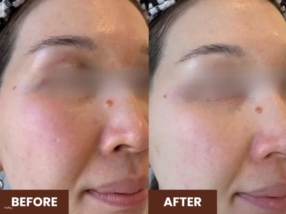 60 Mins Kohaku Vampire Lifting Facial @ Ikeda Spa in Bukit Timah | Experience the Art of Japanese Spa in Singapore
