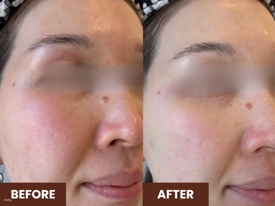60 Mins Kohaku Vampire Lifting Facial @ Ikeda Spa in Bukit Timah | Experience the Art of Japanese Spa in Singapore