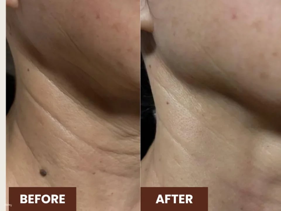 60 Mins Kohaku Vampire Lifting Facial @ Ikeda Spa in Bukit Timah | Experience the Art of Japanese Spa in Singapore